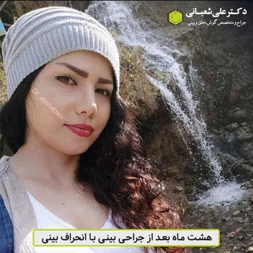 جراحی-بینی-482