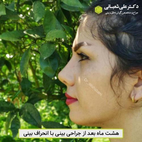 جراحی-بینی-483