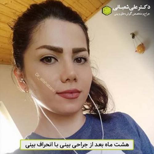جراحی-بینی-484