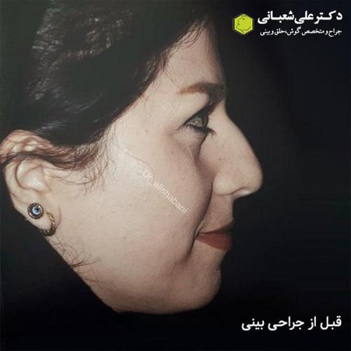 جراحی-بینی-485