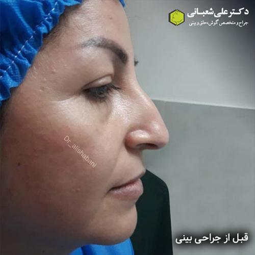 جراحی-بینی-496