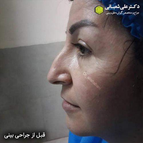 جراحی-بینی-497