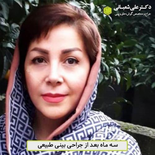 جراحی-بینی-498