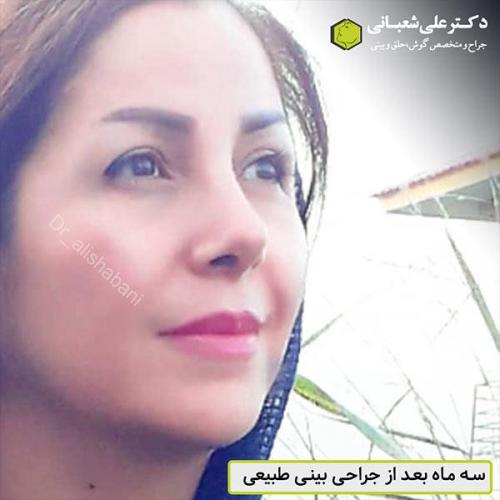 جراحی-بینی-500