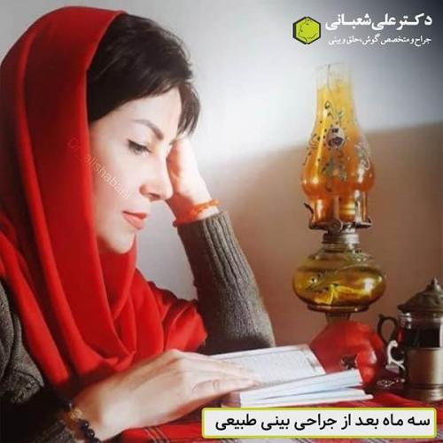 جراحی-بینی-501