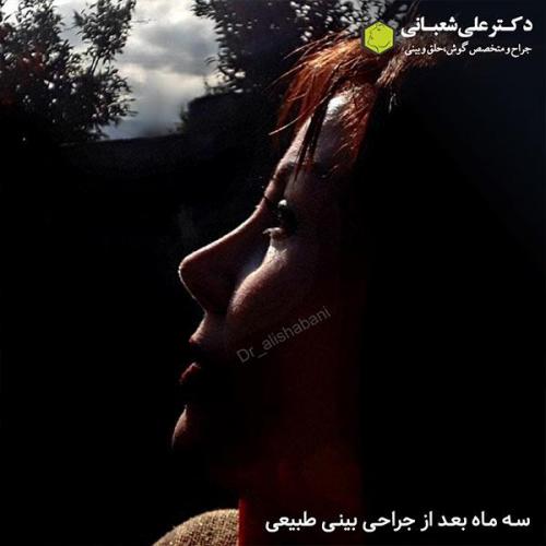 جراحی-بینی-502