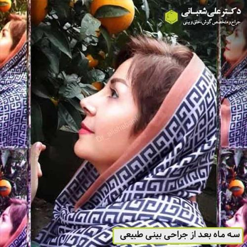 جراحی-بینی-503