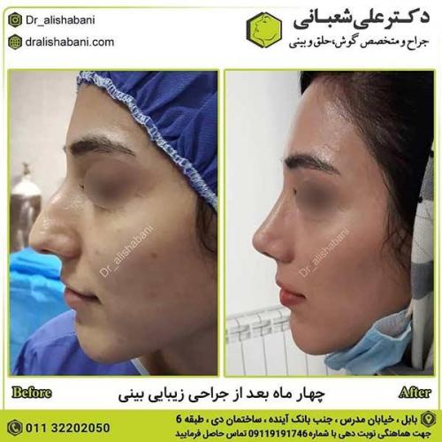 جراحی-بینی-504