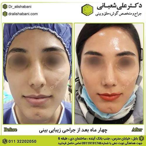جراحی-بینی-505