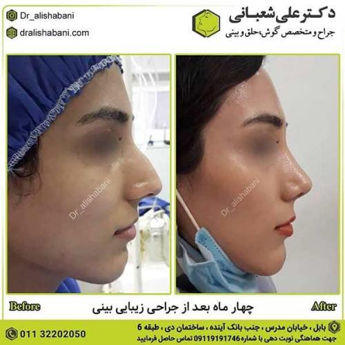 جراحی-بینی-507