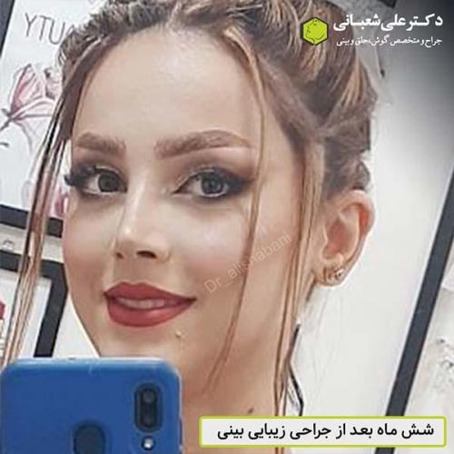 جراحی-بینی-512