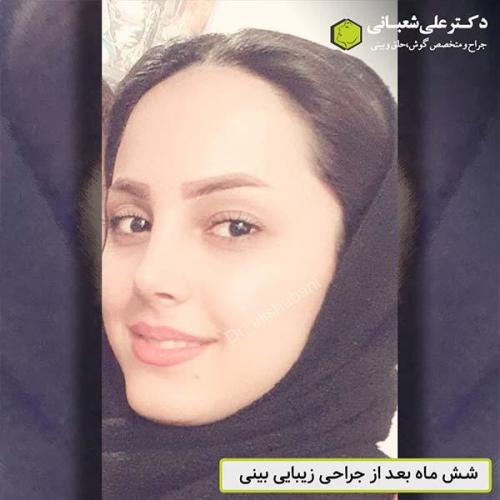 جراحی-بینی-513