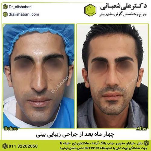 جراحی-بینی-531
