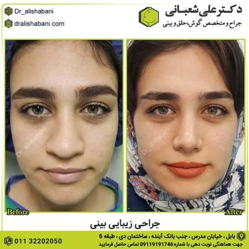 جراحی-بینی-536