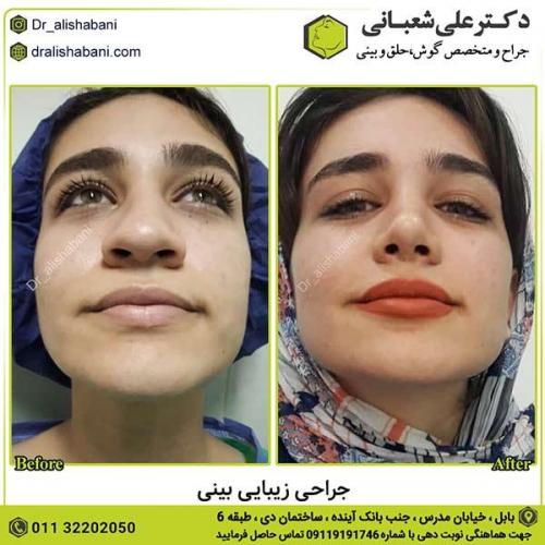 جراحی-بینی-537