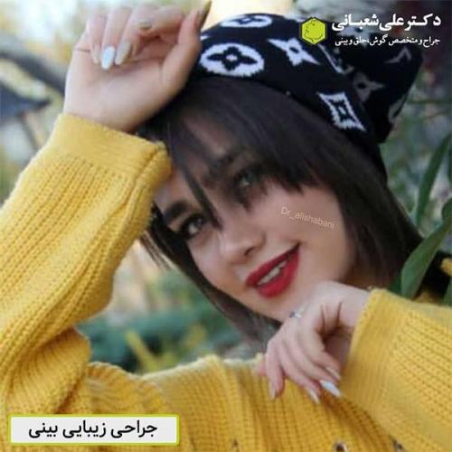 جراحی-بینی-538