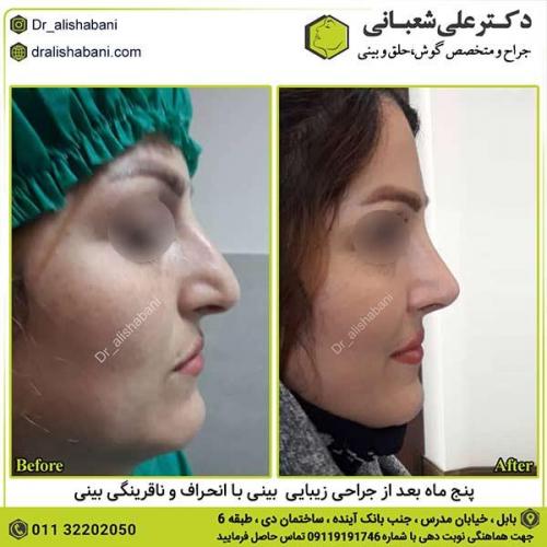 جراحی-بینی-539