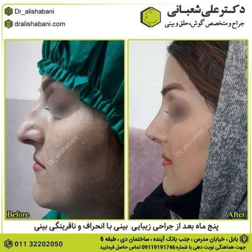 جراحی-بینی-540