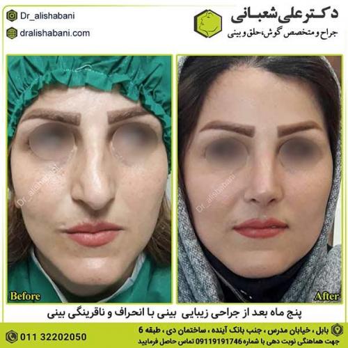 جراحی-بینی-542