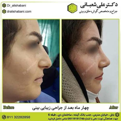 جراحی-بینی-543