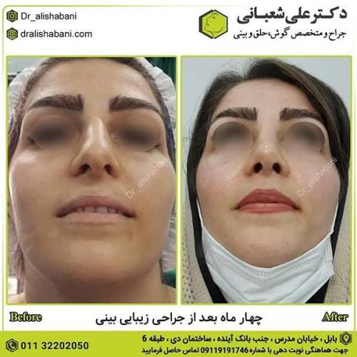 جراحی-بینی-544