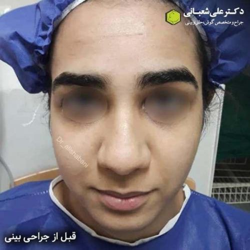 جراحی بینی 600 (11)