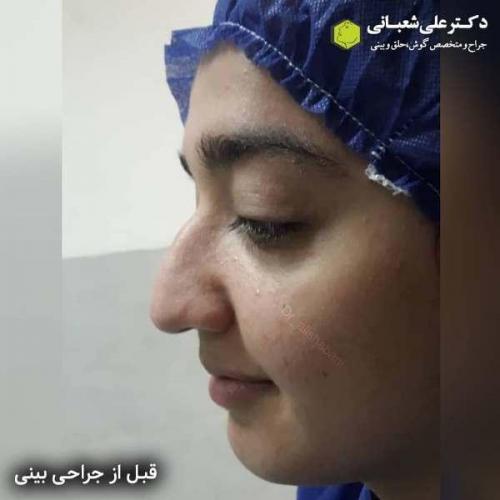 جراحی بینی 600 (114)