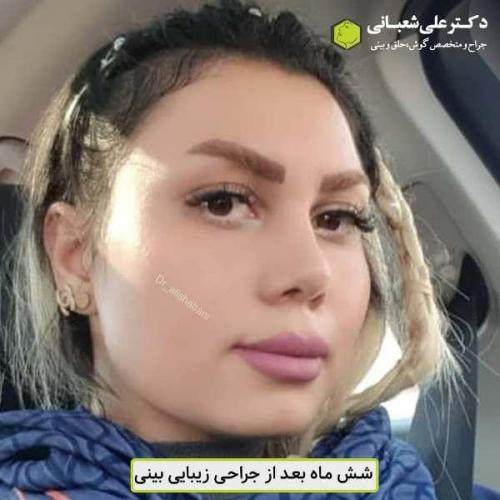 جراحی بینی 600 (12)