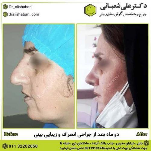 جراحی بینی 600 (4)