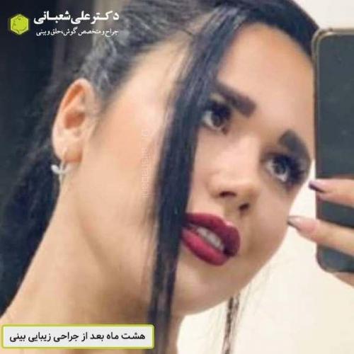 جراحی بینی 600 (55)