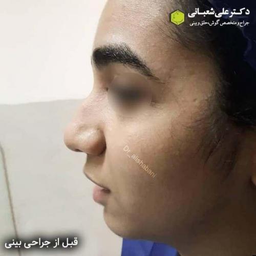 جراحی بینی 600 (6)