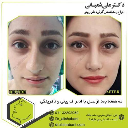 جراحی-بینی-100