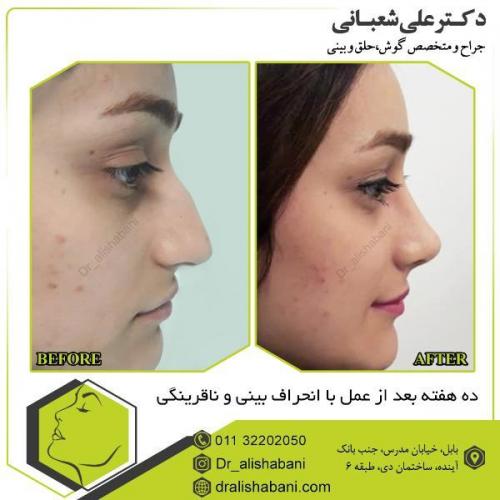 جراحی-بینی-101