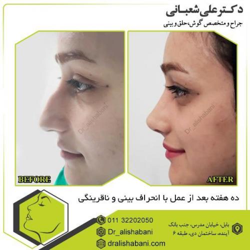 جراحی-بینی-102