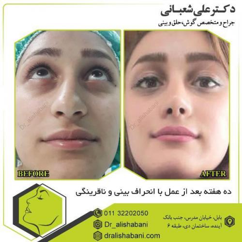 جراحی-بینی-103