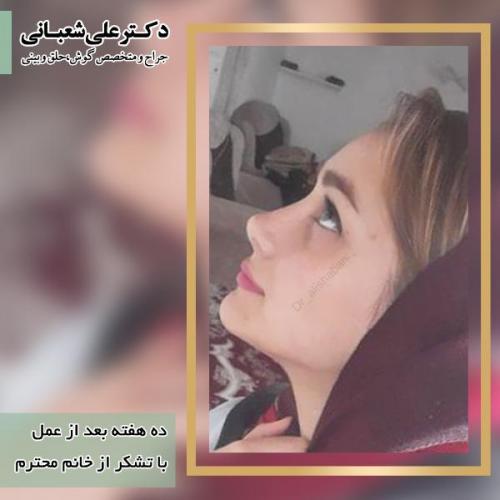جراحی-بینی-105