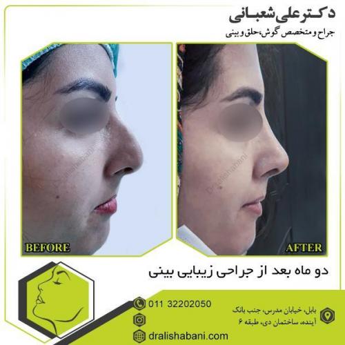 جراحی-بینی-107