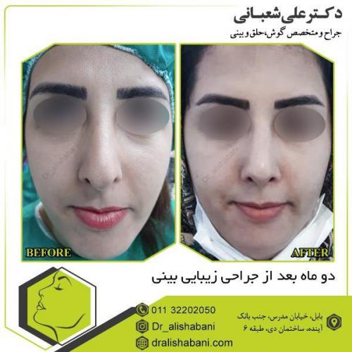 جراحی-بینی-108