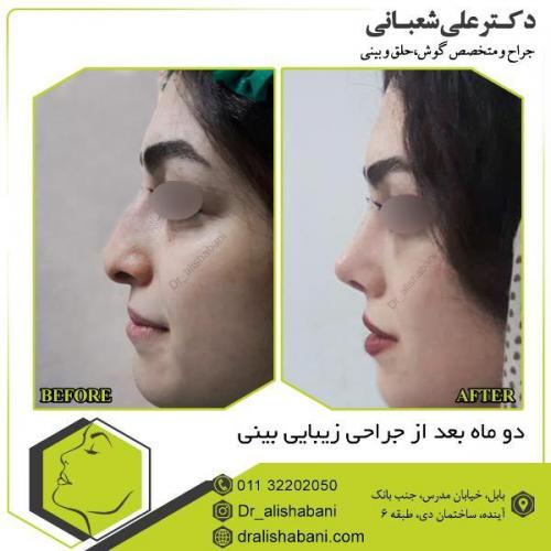 جراحی-بینی-109