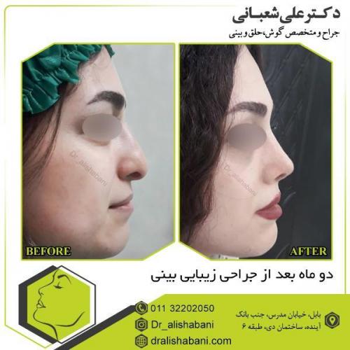 جراحی-بینی-110