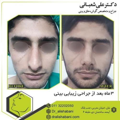 جراحی-بینی-112