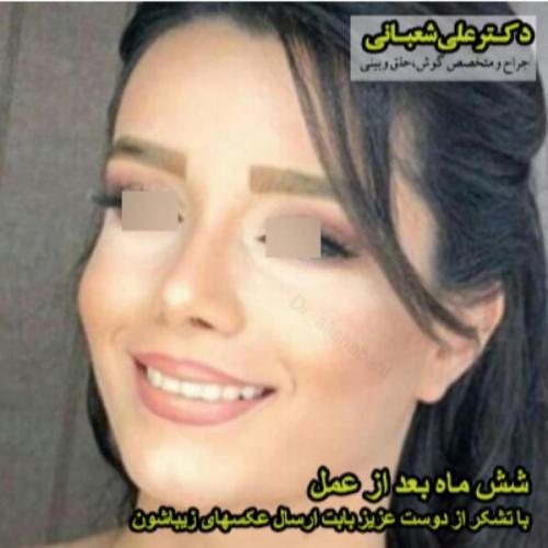 جراحی-بینی-115
