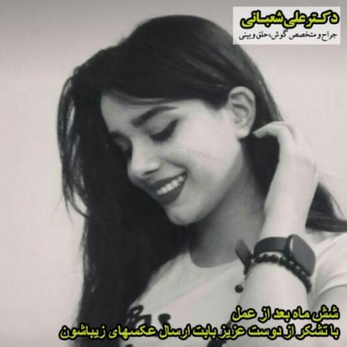 جراحی-بینی-116