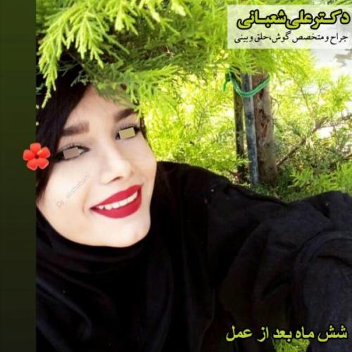 جراحی-بینی-119