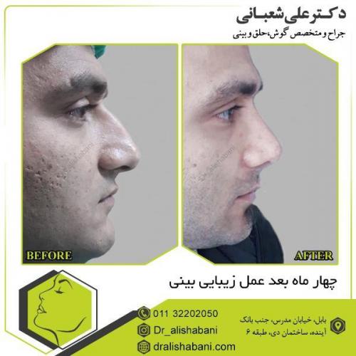 جراحی-بینی-120
