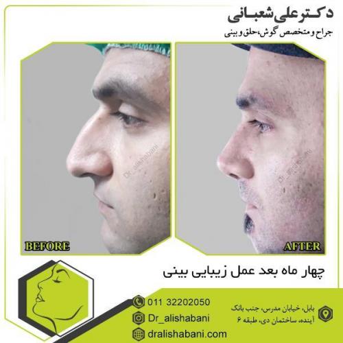 جراحی-بینی-121
