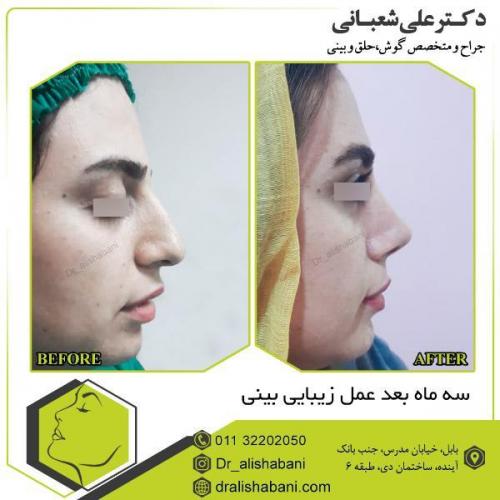 جراحی-بینی-124