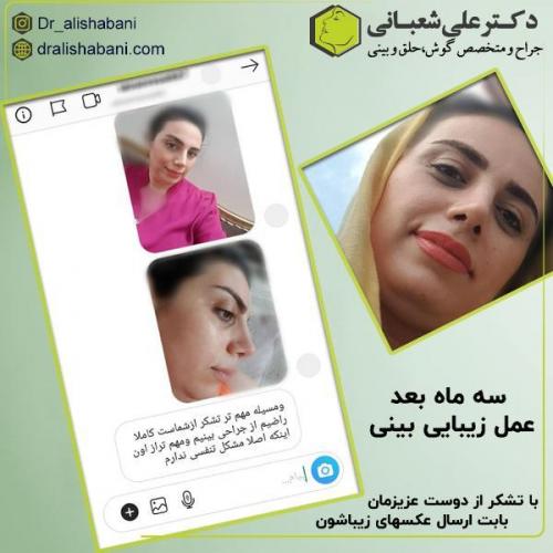 جراحی-بینی-125