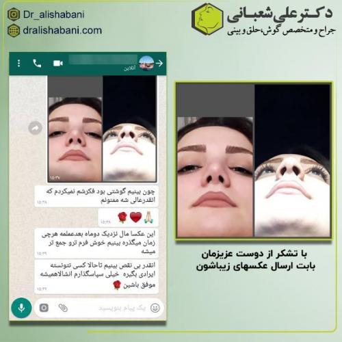 جراحی-بینی-131