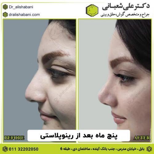 جراحی-بینی-132